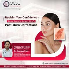 Orissa Cosmetic Surgery Clinic, advancing the path in aesthetic and reconstructive procedures, holds a prime place in the field of burn and plastic surgery in Bhubaneswar. From minimally-invasive procedures to complex surgical corrections, our team prides itself in providing unparalleled service quality in a patient-friendly environment. Our Burn Plastic Surgery Clinic in Bhubaneswar employs modern surgical techniques and innovative solutions that result in minimal discomfort and quick recovery time. Redefining looks and restoring identity, Orissa Cosmetic Surgery Clinic is committed to bringing out the best version of you.

Know more: https://orissacosmeticsurgery.com/post-burn-deformity-correction/