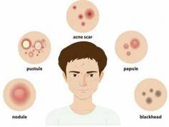 Acne and pimples can affect individuals of all ages, leading to distress and self-esteem issues. Understanding the causes and treatment options is key to managing these common skin conditions. Pimples form when hair follicles become clogged with oil and dead skin cells, often exacerbated by hormonal changes, genetics, diet, stress, skincare products, and environmental factors.

Effective treatments range from over-the-counter options like benzoyl peroxide and salicylic acid to prescription medications such as topical retinoids, antibiotics, and oral isotretinoin. Additionally, dermatological procedures like chemical peels, laser therapies, and corticosteroid injections can provide significant improvements, especially for severe cases.

For personalized acne treatment in Hyderabad, FMS Skin & Hair Clinics offer comprehensive solutions tailored to your skin type and condition. Achieve clearer, healthier skin with our expert dermatological care.

For more information, visit FMS Skin & Hair Clinics: https://www.fmsskin.com/pimple-treatment-in-hyderabad/