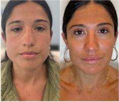 Looking for PRP microneedling near me? Allie Aesthetics specializes in this advanced skincare treatment combining microneedling with platelet-rich plasma (PRP) therapy. PRP microneedling stimulates collagen production and rejuvenates skin texture, addressing fine lines, acne scars, and uneven tone effectively. Their experienced practitioners offer personalized sessions tailored to your skincare needs, ensuring natural-looking results and enhanced skin vitality. Located conveniently, Allie Aesthetics prioritizes client comfort and satisfaction, providing a professional environment for transformative skincare treatments. Explore their website to discover more about PRP microneedling benefits and schedule a consultation to achieve radiant and rejuvenated skin.