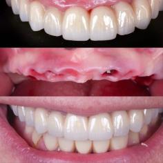 Descubra los precios competitivos de los implantes dentales en MAG Dental en Madrid. Nuestro equipo de expertos ofrece implantes dentales de máxima calidad con atención personalizada. Recupere su sonrisa con nuestras soluciones asequibles y avanzadas. Reserve su consulta hoy y disfrute de los servicios dentales excepcionales de MAG Dental.