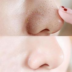 We offer professional blackhead removal for a refreshingly clear, smooth complexion. Get quick relief from express blockage removal services in Long Island City.

