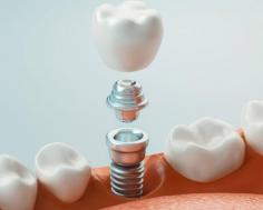 Expert Dental Implants Services Near Fairfield, CT

Restore your smile with expert Dental Implants Near Fairfield CT at Elke Cheung Dentistry. Our skilled team uses advanced techniques to provide durable and natural-looking implants. Trust Elke Cheung Dentistry for reliable and professional dental implant services today. Call us at 203-846-0400.

Visit: https://www.drcheungsmiles.com/