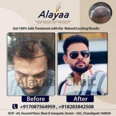 Confused with too many advices? Book your free consult with Alayaa Clinic Hair Transplant clinic in chandigarh for the best advice. Receding Hairline? UndergoHair Transplant Specialist in Chandigarh & say goodbye to baldness. Call Now! Trusted by Celebrities. Experts! Long-Lasting and Quality Hair.