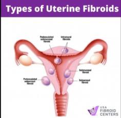 Explore Fibroid Belly Pictures to discover the profound impact fibroids can have on a woman's body through our striking before and after images. Witness the dramatic transformations and learn about the symptoms, causes, and treatments available. Click to explore the visual journey of fibroid belly changes and get informed about this common health issue affecting millions of women worldwide.
Visit Here : https://www.usafibroidcenters.com/blog/pictures-of-fibroids/
