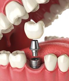If you are in need of Affordable Dental Implants in Manhattan, Studio Smiles NYC is the right place for you. We work with you and your budget to get you the care your need.

https://studiosmilesnyc.com/affordable-dentist/