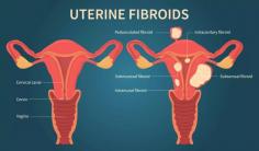 Explore a comprehensive gallery of fibroid pictures to better understand the appearance and impact of uterine fibroids. Learn more about fibroid types, symptoms, and treatment options with detailed visual examples. 