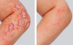 Psoriasis disorder therapy concentrates on diminishing inflammation and clearing skin eruptions. Options consist of surface treatments like creams and salves, phototherapy, and body-wide medications, including biologic therapies. Each therapy is adjusted to the intensity of manifestations and specific health profiles, with the aim of minimizing episodes and improving overall skin health. Lifestyle modifications, such as stress management and a nutritious diet, also have a crucial role. For additional info click here: https://oleumcottage.com/