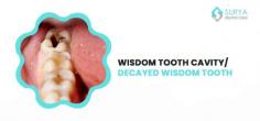 Wisdom teeth are more prone to cavities than other teeth. Because they are located in the back of the mouth so brushing and flossing is extremely challenging. FOR MORE INFO VISIT: https://www.suryadentalcare.com/wisdom-tooth-cavity-decayed-wisdom-tooth/