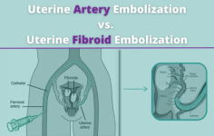 Uterine Artery Embolization: Your Path to Fibroid Freedom
Are you seeking a non-surgical solution for fibroid treatment? Uterine Artery Embolization (UAE) offers a safe and effective alternative to invasive procedures. At USA Fibroid Centers, we specialize in this minimally invasive treatment that targets the blood supply to fibroids, shrinking them and alleviating symptoms without the need for major surgery. UAE is ideal for women who want to preserve their uterus and enjoy a quicker recovery time. Our expert physicians use cutting-edge technology to perform UAE, ensuring the best possible outcomes. Say goodbye to the discomfort and limitations caused by fibroids—take control of your health with uterine artery embolization. Contact us today to learn more about how this procedure can benefit you.
Visit- https://www.usafibroidcenters.com/blog/uterine-artery-embolization-vs-uterine-fibroid-embolization/