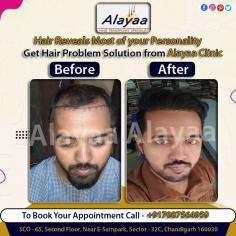 Transform your appearance and regain your confidence with our hair transplant services in Chandigarh. Our skilled team of experts offer the best and most natural-looking results. Book your consultation today Hair Transplant Clinic in Chandigarh