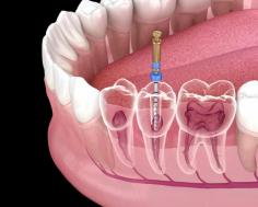 Are you looking for the best Clinic for Root Canal Treatment in Katong? Then visit Meiplus Dentalcare (Marine Parade). They offer a wide range of dental treatments, including preventive care, restorative dentistry, cosmetic dentistry, orthodontics, and oral surgery. Visit- https://maps.app.goo.gl/cSrWEWsAhoxNNkgE8