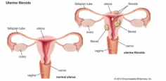 Are you dealing with the discomfort of an enlarged uterus? Understanding the causes of a swollen uterus can be the first step toward finding effective treatment. At USA Fibroid Centers, our specialists are dedicated to providing you with personalized care to address your unique symptoms.
Uterine fibroids are a common cause of a swollen uterus, leading to heavy periods, pelvic pain, and frequent urination. Our non-surgical treatment options, including Uterine Fibroid Embolization (UFE), offer a quick recovery and minimal downtime, allowing you to return to your daily activities swiftly.
Don't let fibroids control your life. Take charge and consult our experienced team at USA Fibroid Centers. Our state-of-the-art facilities and compassionate care will help you find the relief you deserve. Schedule your consultation today and embrace a life free from fibroid pain.
Visit- https://www.usafibroidcenters.com/uterine-fibroid-symptoms/enlarged-uterus/