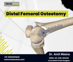 A distal femoral osteotomy (knock knee surgery) is a procedure whereby a surgical fracture is created at the end of the femur and the shape of the bone is changed. In general, these are performed for patients with knock knees, which we call valgus alignment, and the goal of the surgery is to realign them such that the weightbearing axis is changed to pass either through the center of the knee or just barely into the inside compartment of the knee.