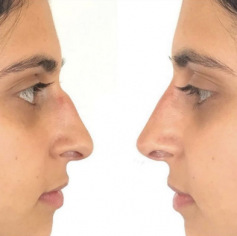 Our products achieved excellent results.A lip filler that contains a local anaesthetic to minimise discomfort during the procedure. It comes in a 0.55ml syringe and we are careful to make sure the treatment is likely to give a pleasing aesthetic result and that each client’s expectations are realistic.

Know more: https://www.regentstreetclinic.co.uk/lip-fillers-lincoln/