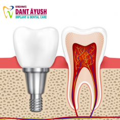 Our best Root Canal treatment relieves tooth pain by removing infected tissue from inside the tooth. We clean, fill, and seal it to save your tooth and restore your smile. It’s a quick, effective solution