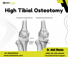 KneeCares Clinic in Jaipur, proudly offer high tibial osteotomy (HTO) as part of our comprehensive orthopedic care. Led by one of the best orthopedic surgeons in Jaipur, Our clinic specializes in advanced joint knee replacement, including Total Knee Replacement and Hip Replacement Surgery.
