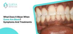 The hidden factors behind black gum disease and what causes blackness on gums are discussed in this blog post. For more info visit: https://www.suryadentalcare.com/what-is-black-gum-disease/