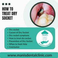 Find out about the causes, signs, and remedies of dry socket. Learn how to properly avoid and treat this excruciating disease that follows tooth extraction.