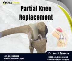 At KneeCares Clinic in Jaipur, we specialize in partial knee replacement surgeries, providing cutting-edge solutions for joint pain and mobility issues. Dr. Amit Meena is an internationally renowned knee surgeon who offers personalized care for the best possible outcomes. Whether you’re considering a knee replacement, hip replacement, or shoulder surgery, our highly skilled team is dedicated to helping you regain mobility and improve your quality of life. Recognized as the best orthopedic specialist in Jaipur, we provide comprehensive services, from diagnosis to post-surgery rehabilitation. Trust us to deliver top-quality care and restore your joint health.