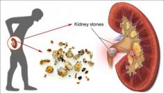 Ayurveda provides a natural and efficient therapy for kidney stones. Nephrolithiasis, or kidney stones, are solid crystalline formations that occur inside the kidneys or urinary system. If left untreated, these stones can cause extreme discomfort, suffering, and even problems. We offer tailored Ayurvedic therapies in Pune at Shree Ayurved & Panchakarma Hospital to assist you in getting rid of kidney stones and restoring your health. Visit more information- https://www.ayurvedhospital.com/kidney-stone.html