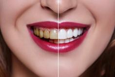 Dr. Meenakshi Tomar can help you achieve a brighter & more beautiful smile. Contact us at (425) 775-5162 for your Teeth Whitening solution in Edmonds, WA.