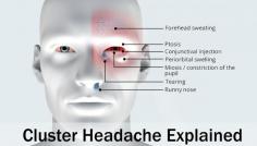 Cluster headaches are one of the most painful types of headaches, often referred to as "suicide headaches." They are characterised by intense pain around one eye or one side of the head, lasting from 15 minutes to several hours. Unlike migraines, cluster headaches occur in cyclical patterns or clusters, often striking at the same time each day. Understanding the symptoms, causes, and relief options can help manage this condition. Common triggers include alcohol, strong smells, and changes in sleep patterns. Watch full video on YouTube https://www.youtube.com/watch?v=JEqHUyN2Lkc