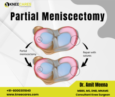 The menisci, crucial components of the knee joint, consist of fibrocartilage and serve as effective shock absorbers. Their structure exhibits an interesting characteristic: the outer third of the meniscus is supplied with blood, while the inner portion lacks this vital supply. Moreover, the inner part is notably thinner than the thicker outer region, which is firmly attached to the joint lining. Consequently, when tears occur in the inner, avascular portion of the meniscus, they typically necessitate resection. In such cases, a surgical procedure known as partial meniscectomy becomes essential to alleviate pain and discomfort caused by the torn segment.
