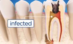 Root canal dentist in Kent, WA. A root canal is a treatment used by dental experts to repair and save severely infected or decayed teeth. Call (253) 529-9434.

Visit our Location:-
27020 Pacific Highway South, Suite C, Kent, WA 98032

