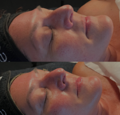 If you’re looking for microneedling with PRP (Platelet-Rich Plasma) near you, this advanced skincare treatment combines the benefits of microneedling with the rejuvenating power of PRP to enhance your skin's appearance. Microneedling creates tiny micro-injuries in the skin, stimulating collagen production and promoting healing. When PRP, derived from your own blood, is applied during the procedure, it enhances skin regeneration and improves texture, tone, and overall radiance. This treatment is effective for reducing fine lines, acne scars, and large pores. By finding a local provider for microneedling with PRP, you can experience personalized care and optimal results in your journey toward healthier, more youthful skin.