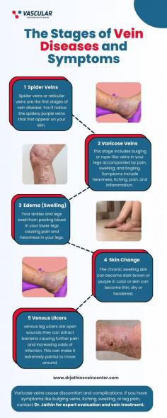 From minor spider veins to painful ulcers, vein disease can significantly affect your health. Early intervention is key. Visit a Varicose Veins doctor in Mumbai at Dr. Jathin's Vein Center for a professional diagnosis and treatment from a leading vein specialist. Regain your comfort and confidence by addressing your vein health concerns before they worsen.