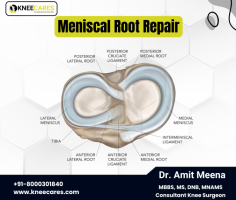 The integrity of the root attachments of the medial and lateral meniscus plays a crucial role in maintaining joint health and stability. When tears compromise these root attachments, it can have significant implications for the joint. Here are some key considerations related to meniscus root injuries and their impact.