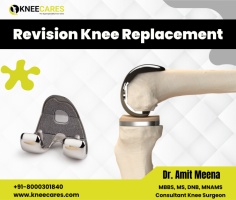 Revision Knee Replacement, often called a "second knee replacement," is a highly intricate surgical procedure designed to address the issues associated with a failed total knee prosthesis. This complex surgery involves replacing the existing knee replacement components with a new one.