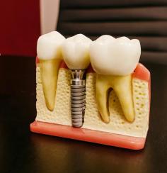 When it comes to tooth replacement, dental implants in Hyderabad stand out as the most reliable option.