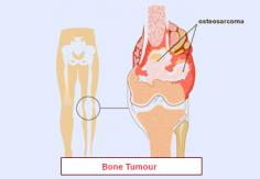 Опухоли костей могут быть доброкачественными или злокачественными, влияя на структуру и функцию кости. Симптомы могут включать боль, отек и переломы. Ранняя диагностика имеет решающее значение для эффективного лечения, которое может включать хирургическое вмешательство, химиотерапию или лучевую терапию. Edhacare свяжет вас с ведущими специалистами-ортопедами, которые предоставят индивидуальный подход для эффективного лечения опухолей костей. Ваше здоровье и выздоровление – наш главный приоритет.