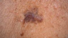 Learn about melanoma in its early stages with expert skin care doctors. Early detection is crucial for effective treatment, as initial symptoms often appear as unusual moles or spots on the skin. Our skilled dermatologists provide comprehensive screening, diagnosis, and treatment plans to ensure the best outcomes. Protect your skin and catch melanoma early—schedule your consultation today!