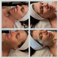 The Dermaplane Facial is a gentle, exfoliating treatment that removes dead skin cells and fine facial hair, leaving skin smooth, soft, and glowing. Using a specialized blade, the esthetician delicately removes the outermost layer of skin, revealing a fresh, radiant complexion. This treatment promotes better absorption of skincare products and creates a smooth base for flawless makeup application. Ideal for all skin types, the Dermaplane Facial helps reduce the appearance of fine lines, acne scars, and dullness. With no downtime, it’s a convenient way to achieve a bright, rejuvenated look that enhances the skin's natural beauty.