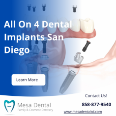 Restore your smile with All On 4 Dental Implants in San Diego at Mesa Dental. This innovative solution provides a full-arch restoration using just four implants, ensuring a natural look, comfort, and long-lasting results. Transform your oral health and confidence with expert care. Schedule your consultation at Mesa Dental today!