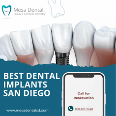 Looking for the best dental implants in San Diego? Mesa Dental offers top-quality implant solutions to restore your smile with natural-looking, long-lasting results. Our experienced team provides personalized care to ensure comfort and satisfaction, helping you regain confidence and functionality. Schedule a consultation today to learn how our dental implants can transform your smile!