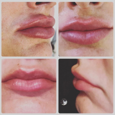 Our doctors have over 20 years experience in lip augmentation procedures and offer a subtle plumping of lips to leave a full-bodied, youthful appearance.

Know more: https://www.regentstreetclinic.co.uk/lip-fillers-leeds-wakefield/