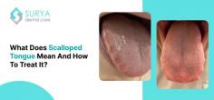 Indentations on the sides of your tongue are generally called scalloped tongue, and some dentists call it tongue crenation. It generally not a serious condition but may signal underlying health issues. For more info visit: https://www.suryadentalcare.com/scalloped-tongue/