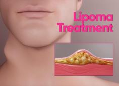 Lipomas may not pose a severe health risk, but they can affect your confidence and comfort. With consistent use of the remedies mentioned above, you may find relief and a reduction in the size of your lipomas. Always consult a healthcare provider before starting any new treatment, especially if you have underlying health conditions.
