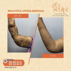 Lipoma treatment in Hyderabad offers patients various options, primarily focusing on surgical removal for those seeking to eliminate these benign fatty tumors. While lipomas are usually painless and harmless, lipoma specialists many individuals opt for surgery for cosmetic reasons or if they cause discomfort. Lipoma surgery price Hyderabad The cost of lipoma surgery in Hyderabad typically ranges depending on several factors, including the choice of hospital,  the surgeon's expertise, lipoma surgery cost Hyderabad and the complexity of the case. Before proceeding, it’s crucial to consult with a qualified healthcare professional cosmetic lipoma treatment hyderabad , who can assess your specific situation and provide a detailed estimate,benign tumor removal hyderabad including any additional costs for pre-operative tests and post-operative care.H Hyderabad medical facilities
Visit On:https://thesculpt.co.in/lipoma-removal-cost-in-hyderabad/