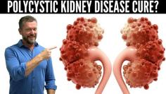 
The quest for a Polycystic Kidney Disease cure is still ongoing, but the progress in gene editing, stem cell therapy, and effective medications provides hope for a brighter future. While waiting for a definitive cure, managing Polycystic Kidney Disease through a combination of medical treatment, lifestyle changes, and the Herbal Treatment for Polycystic Kidney Disease can significantly improve quality of life.
