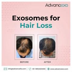 Discover the transformative effects of #exosomes for hair loss before and after​ treatments! With exosome therapy, dermatologists can offer clients a powerful solution that revitalizes hair health by deeply nourishing the scalp and promoting new hair growth. 

At Advancexo, our premium exosomes are crafted specifically for aesthetic and therapeutic use, helping your clients achieve visible results and increased hair density with minimal downtime. Witness firsthand the impact of scientifically-backed innovation in combating hair fall effectively and naturally. Ready to elevate your clinic’s offerings? 

Call us at +91-9654-321-400 for more information on partnering with India’s leading exosome provider.