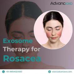 Exosome therapy is creating a new era in rosacea treatment, offering dermatologists an advanced, cellular-based approach for addressing inflammation and redness at the source. By utilizing exosomes for rosacea, skin cells benefit from the targeted communication these tiny messengers provide, helping reduce irritation and support rejuvenation deep within the skin layers. Unlike traditional treatments, exosomes therapy for rosacea aligns with the skin's natural regenerative processes, making it a powerful tool for long-term results in sensitive skin patients.