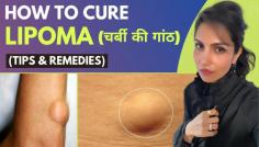 Exploring how to cure lipoma naturally can offer a range of non-invasive options to manage this condition. By incorporating dietary changes, regular exercise, and herbal remedies for lipoma into your routine, you can support your body’s natural ability to metabolize fat and reduce inflammation. However, always consult with a healthcare professional before starting any new treatment, especially if you have underlying health conditions.
