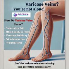 Don't Let Varicose Vein Ulcers Develop Treat At Right Time! | Synerheal Pharmaceuticals.

Description: Varicose ulcers form due to poor blood circulation in the leg veins (chronic venous insufficiency). When vein valves are damaged, blood pools in the veins, increasing pressure and weakening the skin, eventually leading to open sores. If untreated, these ulcers can result in infections, chronic pain, reduced mobility, and recurring wounds that are slow to heal. Synerheal Pharmaceuticals offers advanced collagen-based wound dressings, such as SEESKIN Collagen Sponge and SynerHeal Sterile Collagen Particles, which promote faster healing, prevent infection, and reduce the need for frequent dressing changes, making recovery more effective.

For More Info Visit our website: https://www.synerheal.com

Contact Us: +918925941222 