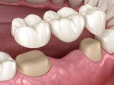 Porcelain crowns are an excellent choice when recreating the form and function of a damaged tooth, because a crown basically replaces the entire external portion of the tooth down to the gum level. Crowns are not limited to simply replacing the original tooth, but can be designed to create an even better esthetic appearance. Visit: https://www.nocoprosth.com/porcelain-crowns/