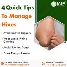 4 Quick Tips To Manage Hives (Urticaria)