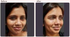 A smile with dimples has universal appeal. It signals warmth, confidence, and youth. For people who don’t have natural dimples, cosmetic science now offers a safe, reliable way to create them. Dimple creation in Delhi is one of the most requested minor facial procedures today, quick, scar-free, and beautifully subtle.